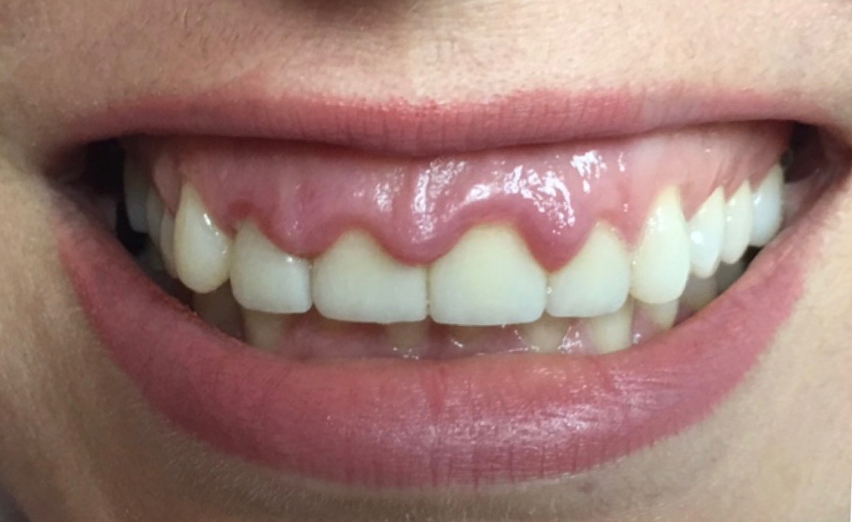Overgrown gums before laser treatment.