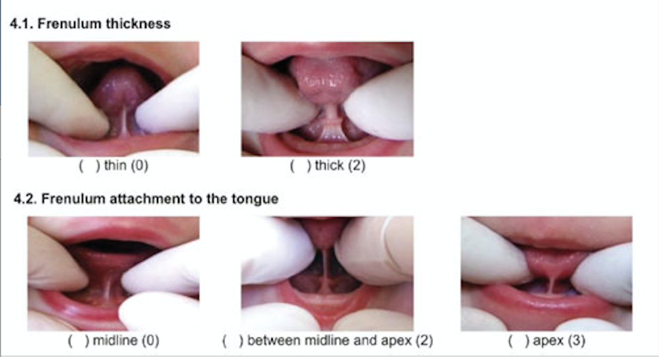 Types of tongue ties.