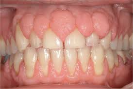 Hyperplastic gums, gingival hyperplasia, gummy smile, overgrown gums